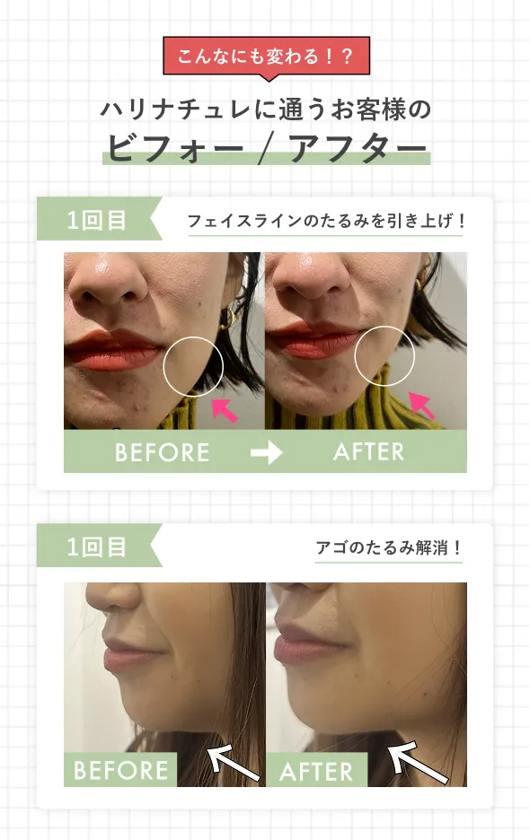 ハリナチュレに通うお客様のビフォー/アフター① フェイスラインのたるみを引き上げ、アゴのたるみ解消