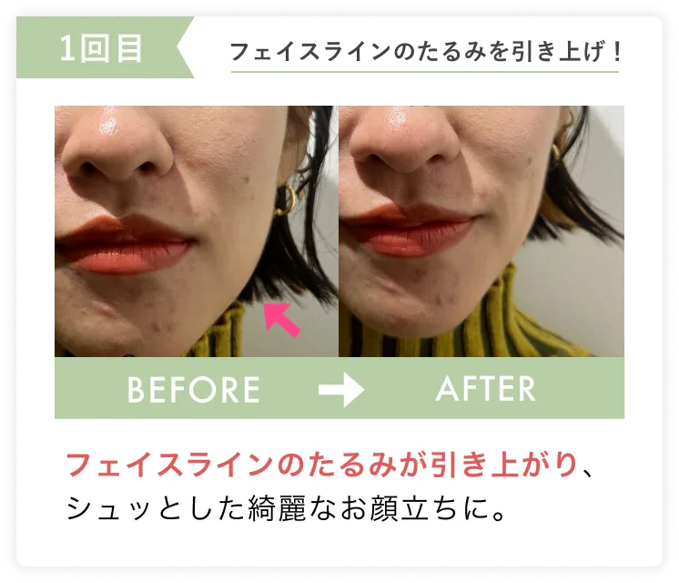 たるみ、むくみ解消で小顔に