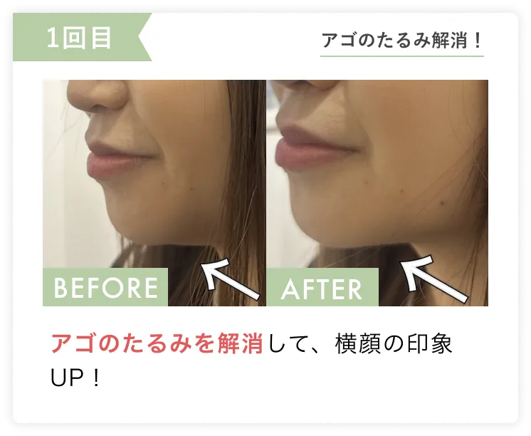 たるみ、むくみ解消で小顔に