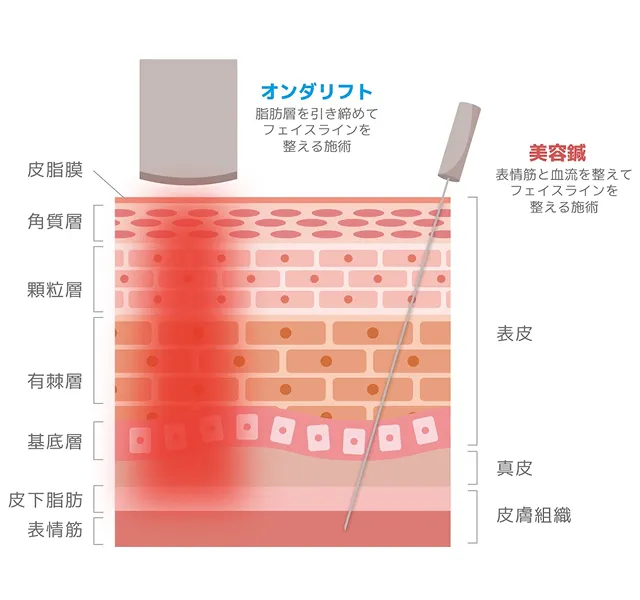 美容鍼とオンダリフトの違い