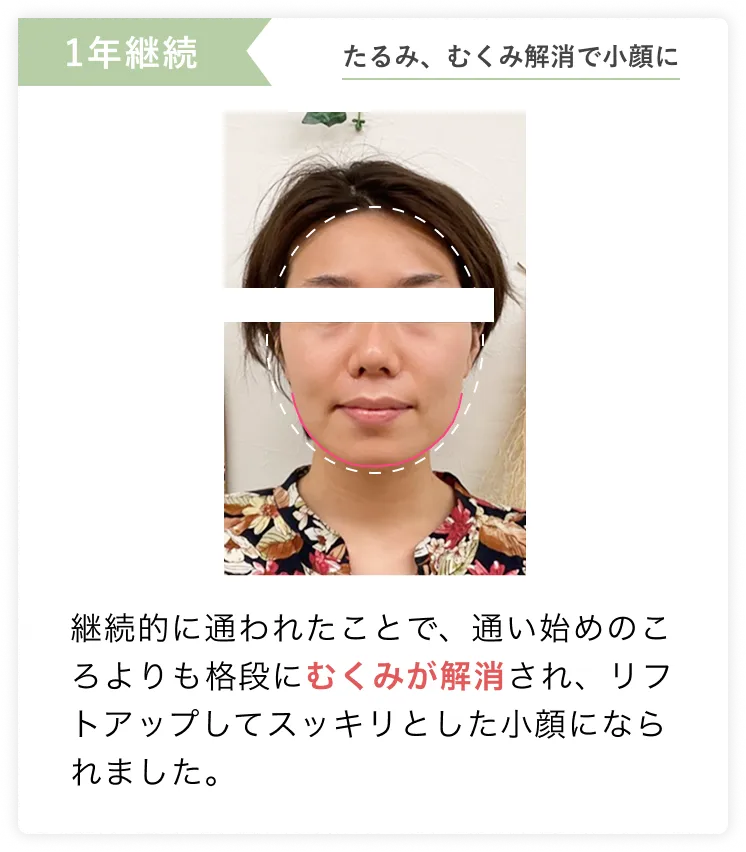 たるみ、むくみ解消で小顔に