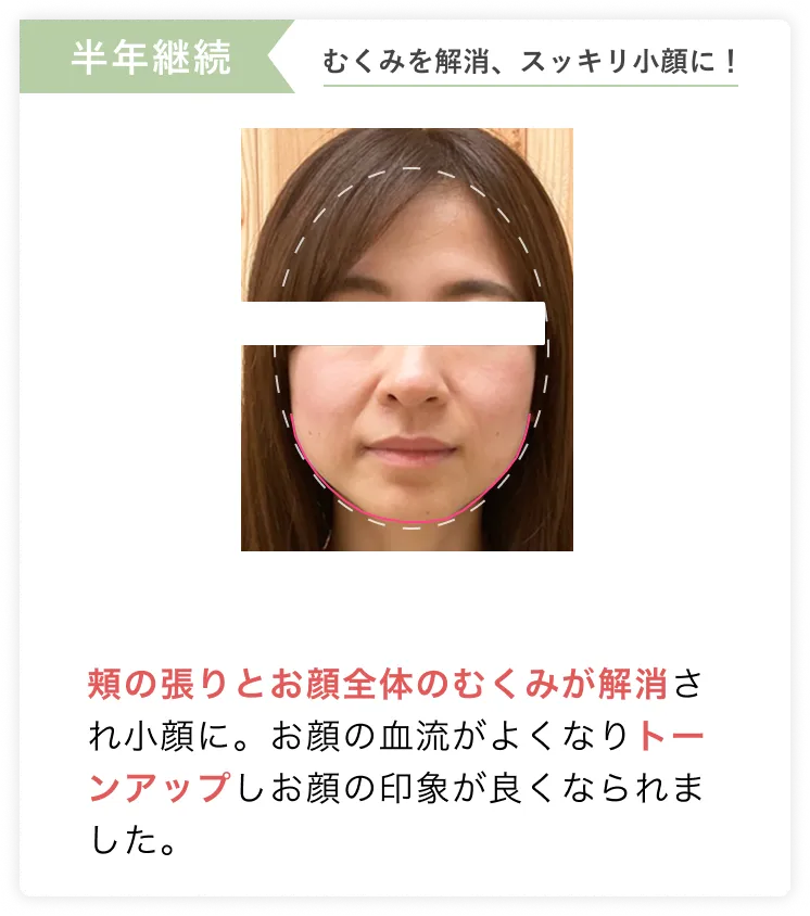 リフトアップでスッキリ小顔に！