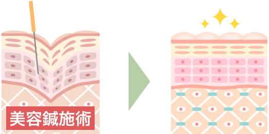 美容施術効果の模式図