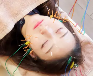 女性が鍼治療をしている様子