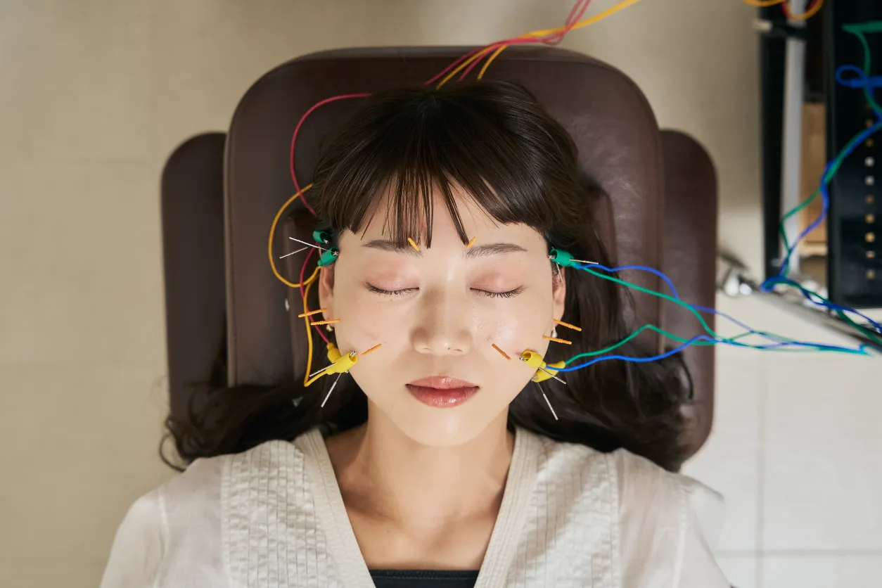 美容鍼のビフォーアフター