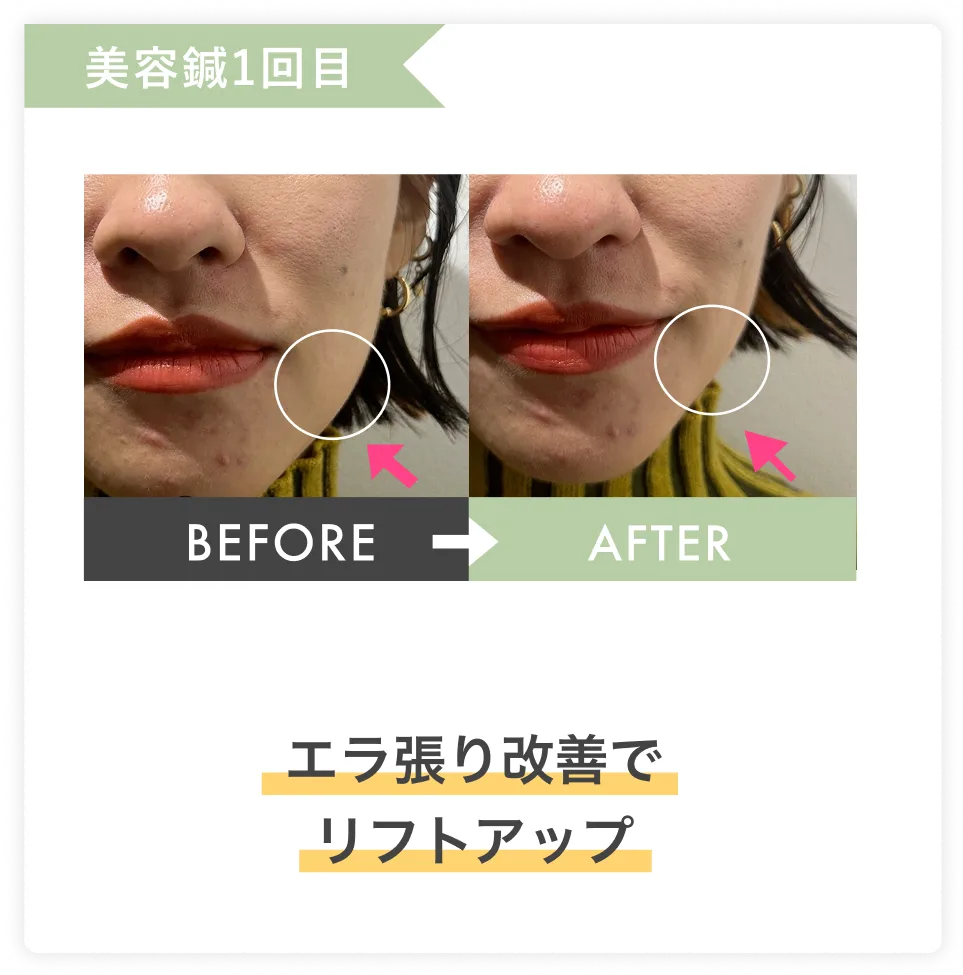 エラ張り改善でリフトアップ