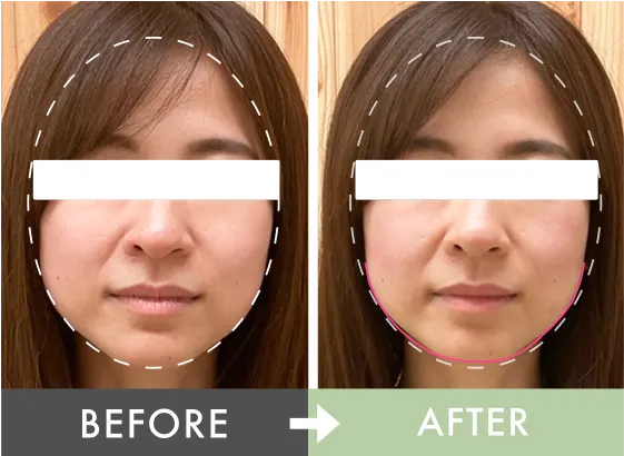 エラ張りが気にならなくなった！