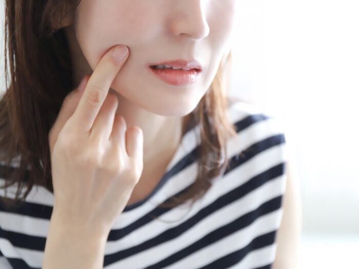 ニキビケアに美容鍼が選ばれる3つの効果