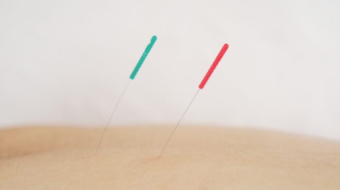 美容鍼の効果を最大限に引き出す方法