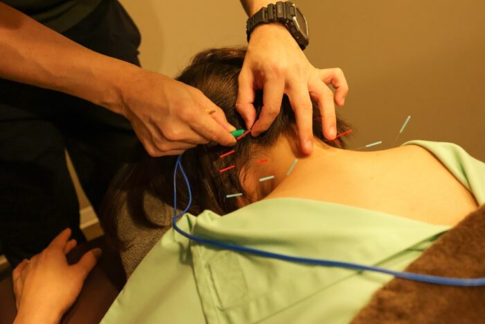 美容鍼で期待できる効果