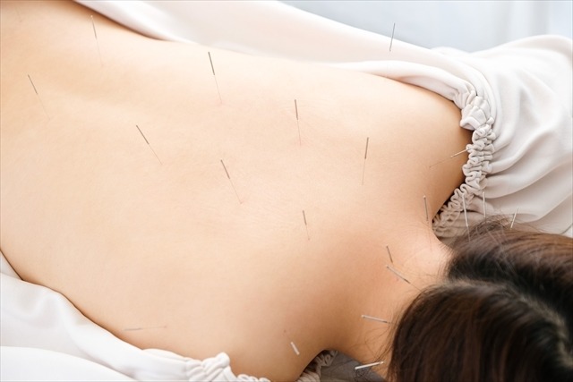 肩こり解消に最適な「美容鍼」とは?