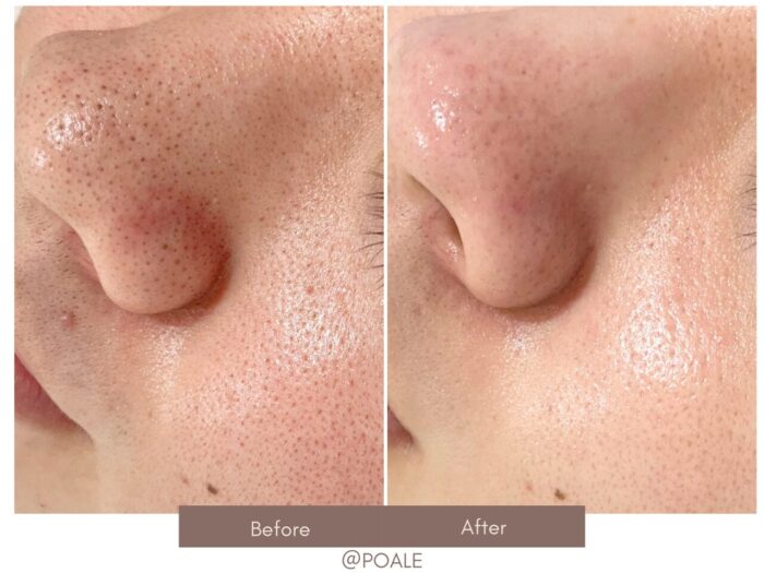 「頑固な黒ずみが無くなりストレスがなくなった」