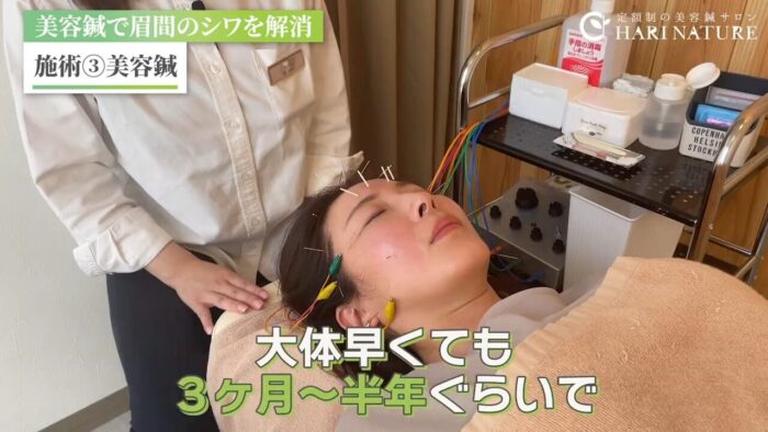 美容鍼　ボトックス