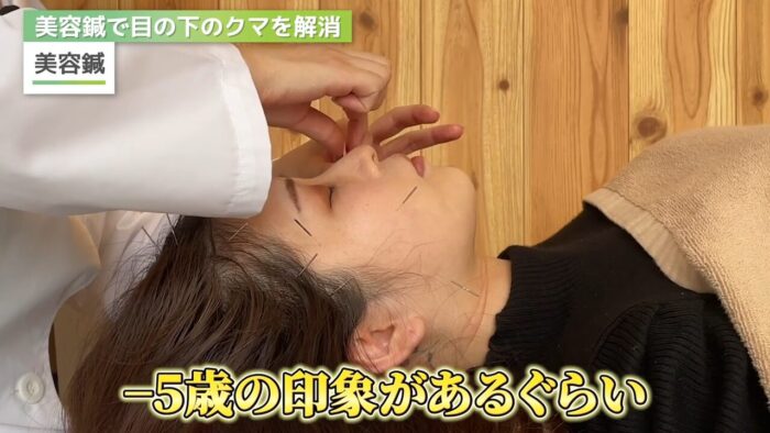 美容鍼 若返り