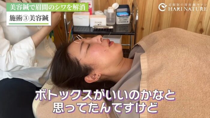 美容鍼　ボトックス