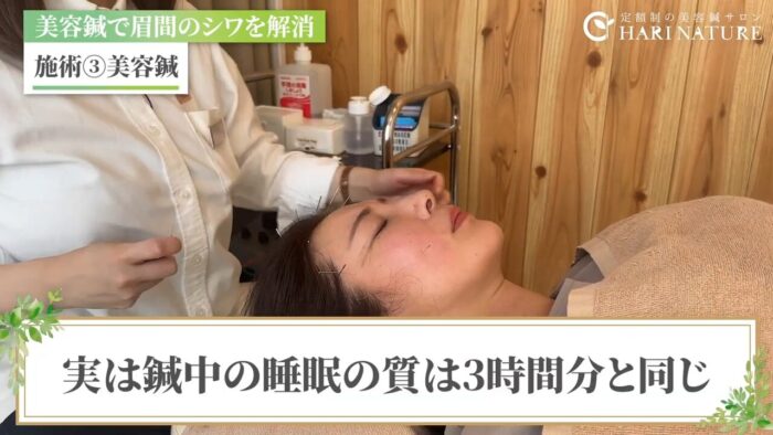 美容鍼　ボトックス