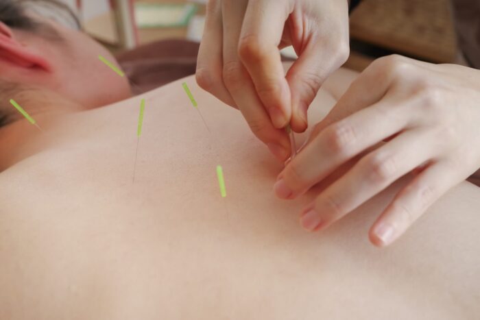美容鍼 生理中
