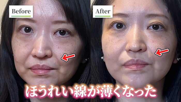 施術後の変化と費用対効果