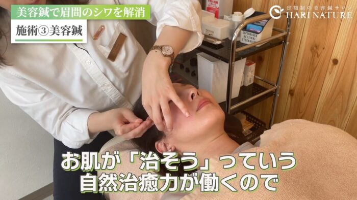 美容鍼　ボトックス