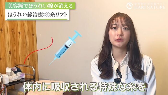 糸リフトの持続性と費用感