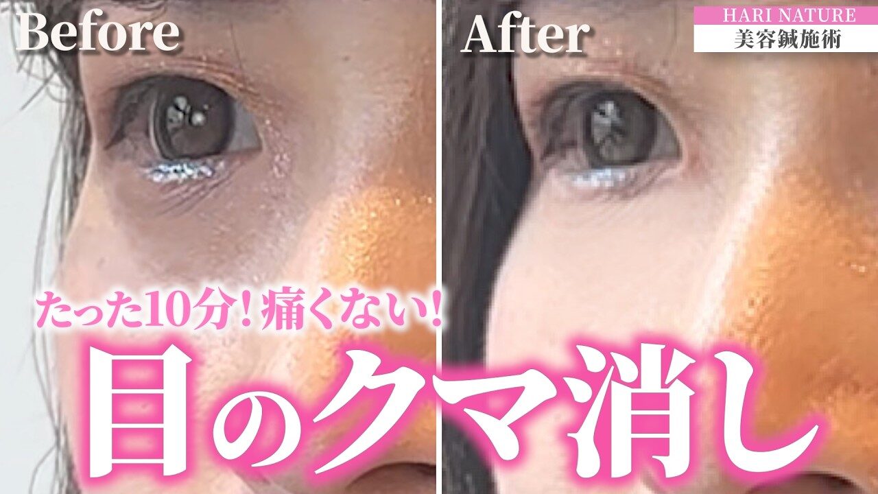 美容鍼　若返り