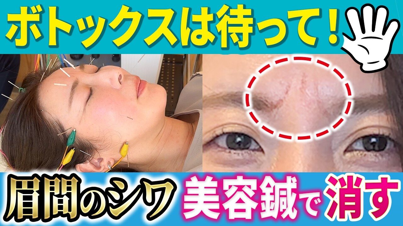 美容鍼　ボトックス