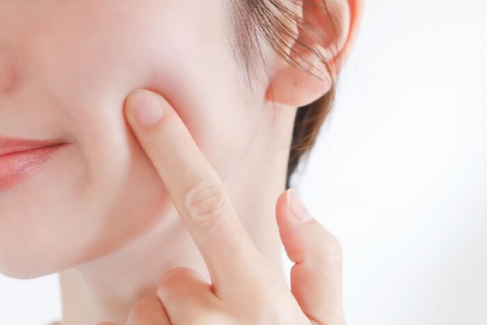 美容鍼で期待できるシミ以外の美容効果とは